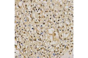 Immunohistochemistry of paraffin-embedded human kidney cancer tissue using H3K79me2 antibody at dilution of 1:200 (x400 lens).