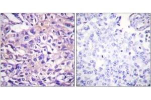 Immunohistochemistry analysis of paraffin-embedded human breast carcinoma, using MYPT1 (Phospho-Thr696) Antibody. (PPP1R12A antibody  (pThr696))