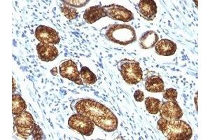 Formalin-fixed, paraffin-embedded human gastric carcinoma stained with Mucin-6 antibody (MUC6/916). (MUC6 antibody)