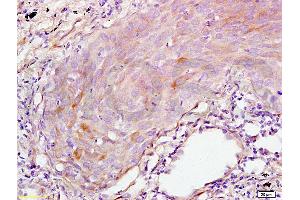 Formalin-fixed and paraffin embedded human lung carcinoma tissue labeled with Anti-S100A7 Polyclonal Antibody, Unconjugated (ABIN718301) at 1:200 followed by conjugation to the secondary antibody and DAB staining (S100A7A antibody  (AA 41-108))