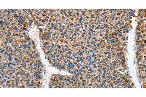 Immunohistochemistry of paraffin-embedded Human liver cancer using DSCR1 Polyclonal Antibody at dilution of 1:45 (RCAN1 antibody)