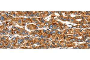 Immunohistochemistry of paraffin-embedded Human liver cancer using ERP44 Polyclonal Antibody at dilution of 1/20 (ERP44 antibody)