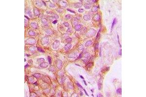 Immunohistochemical analysis of PKC delta (pS645) staining in human breast cancer formalin fixed paraffin embedded tissue section.