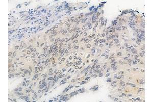 ABIN6256540 and ABIN6267590 at 1/100 staining human cervical carcinoma by IHC-P.