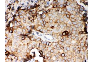 Anti- STIM1 Picoband antibody, IHC(P) IHC(P): Human Mammary Cancer Tissue