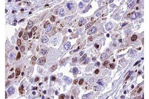 ABIN6267599 at 1/100 staining human lung carcinoma tissue sections by IHC-P. (NF-kB p65 antibody  (pSer468))