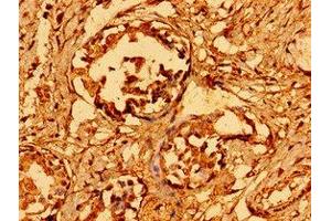 Immunohistochemistry of paraffin-embedded human breast cancer using  at dilution of 1:100 (GAB1 antibody  (AA 119-329))