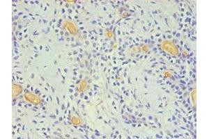 Immunohistochemical of paraffin-embedded Human breast cancer using ABIN7140934 (2E11-2B5) at dilution of 1:200. (CD59 antibody)
