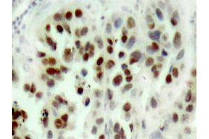 Immunohistochemical analysis of paraffin-embedded human breast cancer tissue using Tp53 polyclonal antibody . (p53 antibody)