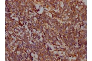 IHC image of ABIN7127482 diluted at 1:100 and staining in paraffin-embedded human lung cancer performed on a Leica BondTM system. (Recombinant FAK antibody)