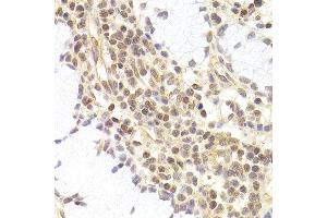 Immunohistochemistry of paraffin-embedded human adenomyosis using PHC1 antibody at dilution of 1:200 (400x lens).