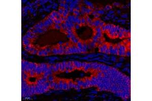 Immunofluorescence of paraffin embedded human colon cancer using NRP2 (ABIN7074826) at dilution of 1: 650 (400x lens) (NRP2 antibody)