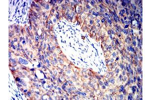 Immunohistochemical analysis of paraffin-embedded cervical cancer tissues using CTNNB1 mouse mAb with DAB staining. (CTNNB1 antibody  (AA 1-100))