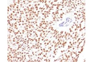IHC testing of FFPE human bladder carcinoma with FOXA1 antibody. (FOXA1 antibody  (AA 372-472))