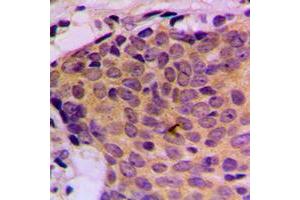 Immunohistochemical analysis of STAT5 staining in human breast cancer formalin fixed paraffin embedded tissue section. (STAT5A antibody  (C-Term))