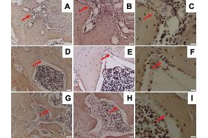 Representative images of immunohistochemical OPG expression in the mandible of Wistar rats in diabetic group with ×200 magnification (A), ×400 magnification (B), ×1,000 magnification (C); osteoporotic group with ×200 magnification (D), ×400 magnification (E), ×1,000 magnification (F); and control group with ×200 magnification (G), ×400 magnification (H), ×1,000 magnification (I); and OPG-positive cells were observed (red arrow).