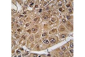 IHC analysis of FFPE human hepatocarcinoma tissue stained with SUMO2/3 antibody (SUMO2/3 antibody  (AA 53-84))