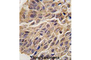 Formalin-fixed and paraffin-embedded human lung carcinomareacted with IDO1 polyclonal antibody , which was peroxidase-conjugated to the secondary antibody, followed by AEC staining. (IDO1 antibody  (C-Term))