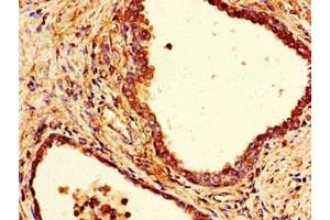 Immunohistochemistry of paraffin-embedded human prostate cancer using ABIN7148014 at dilution of 1:100