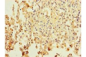 Immunohistochemistry of paraffin-embedded human lung cancer using ABIN7162702 at dilution of 1:100 (PAXIP1 antibody  (AA 613-812))
