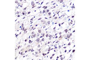 Immunohistochemistry of paraffin-embedded human bladder cancer using FTO Rabbit mAb (ABIN1679842, ABIN3018203, ABIN3018204 and ABIN7101583) at dilution of 1:100 (40x lens). (FTO antibody)
