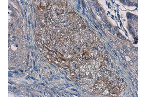 IHC-P Image Interleukin-24 antibody [C2C3], C-term detects Interleukin-24 protein at cytoplasm in human esophageal cancer by immunohistochemical analysis. (IL-24 antibody  (C-Term))