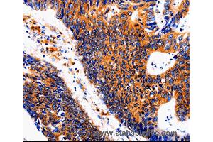 Immunohistochemistry of Human colon cancer using IL18BP Polyclonal Antibody at dilution of 1:50