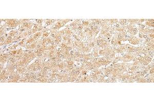 Immunohistochemistry of paraffin-embedded Human liver cancer tissue using NUDT19 Polyclonal Antibody at dilution of 1:25(x200) (NUDT19 antibody)