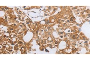 Immunohistochemistry of paraffin-embedded Human lung cancer using MUC20 Polyclonal Antibody at dilution of 1:40 (MUC20 antibody)