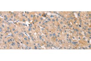 Immunohistochemistry of paraffin-embedded Human liver cancer tissue using STK16 Polyclonal Antibody at dilution of 1:30(x200) (STK16 antibody)