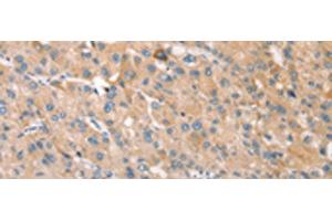 Immunohistochemistry of paraffin-embedded Human liver cancer tissue using STK16 Polyclonal Antibody at dilution of 1:30(x200) (STK16 antibody)