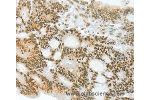 Immunohistochemistry of Human colon cancer using ANGPT4 Polyclonal Antibody at dilution of 1:70 (Angiopoietin 4 antibody)