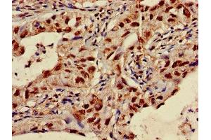 Immunohistochemistry of paraffin-embedded human lung cancer using ABIN7170231 at dilution of 1:100 (SLC35F2 antibody  (AA 335-374))