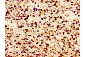 Immunohistochemistry of paraffin-embedded human glioma using ABIN7157174 at dilution of 1:100 (JAM3 antibody  (AA 119-235))