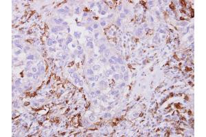 IHC-P Image Iba1 antibody detects Iba1 protein at cytoplasm on human breast cancer stroma by immunohistochemical analysis. (Iba1 antibody)