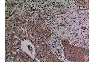 Immunohistochemistry (IHC) analysis of paraffin-embedded Human Breast Cancer, antibody was diluted at 1:100. (MCL-1 antibody  (Internal Region))
