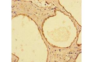 Immunohistochemistry of paraffin-embedded human prostate cancer using ABIN7156292 at dilution of 1:100 (IMPDH2 antibody  (AA 5-514))