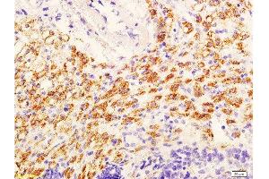 Formalin-fixed and paraffin embedded mouse tumor with labeled Anti-phospho-AKT/PKB(Ser473) Polyclonal Antibody, Unconjugated  at 1:600, followed by conjugation to the secondary antibody and DAB staining (AKT 1/2/3 antibody  (pSer473))