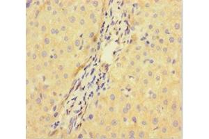 Immunohistochemistry of paraffin-embedded human liver cancer using ABIN7149517 at dilution of 1:100 (DDB1 and CUL4-Associated Factor 1 (DCAF1) (AA 647-745) antibody)