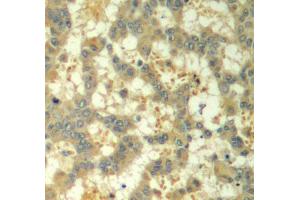 Immunohistochemistry of paraffin-embedded human breast carcinoma using Phospho-SYK-Y323 antibody (ABIN2987845). (SYK antibody  (pTyr323))