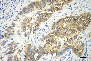 Immunohistochemistry was performed on paraffin-embedded human sigmoid colon carcinoma using catenin beta 1 antibody (ABIN7797926), 1:200). (CTNNB1 antibody)