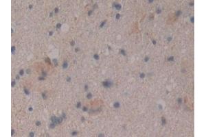 Detection of CD109 in Human Glioma Tissue using Polyclonal Antibody to Cluster Of Differentiation 109 (CD109) (CD109 antibody  (AA 1146-1390))