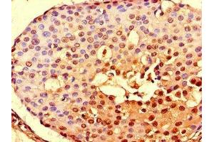 Immunohistochemistry of paraffin-embedded human breast cancer using ABIN7161302 at dilution of 1:100 (NOTCH3 antibody  (AA 1301-1496))