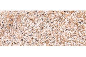 Immunohistochemistry of paraffin-embedded Human liver cancer tissue using RUSC1 Polyclonal Antibody at dilution of 1:90(x200)