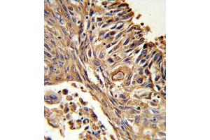 Formalin-fixed and paraffin-embedded human lung carcinoma reacted with IL18R Antibody (N-term), which was peroxidase-conjugated to the secondary antibody, followed by DAB staining. (IL18RAP antibody  (N-Term))
