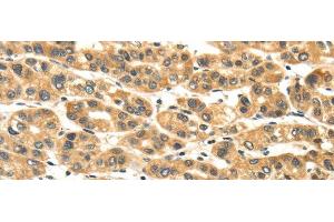 Immunohistochemistry of paraffin-embedded Human liver cancer tissue using NME8 Polyclonal Antibody at dilution 1:45 (TXNDC3/NME8 antibody)
