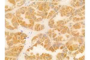 ABIN6256882 and ABIN6274575 at 1/100 staining human renal cell carcinoma by IHC-P. (Serotonin Receptor 4 antibody  (C-Term))