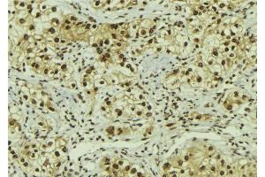 ABIN6267079 at 1/100 staining Human breast cancer tissue by IHC-P. (AC-FKHR antibody)