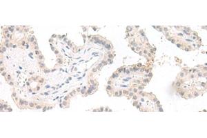 Immunohistochemistry of paraffin-embedded Human thyroid cancer tissue using GHDC Polyclonal Antibody at dilution of 1:90(x200) (GHDC antibody)