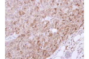 IHC-P Image Immunohistochemical analysis of paraffin-embedded CL1-5 xenograft, using VGAT, antibody at 1:500 dilution. (SLC32A1 antibody  (N-Term))